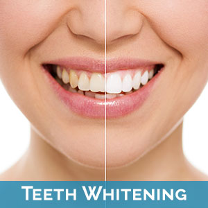 Teeth Whitening in Temple